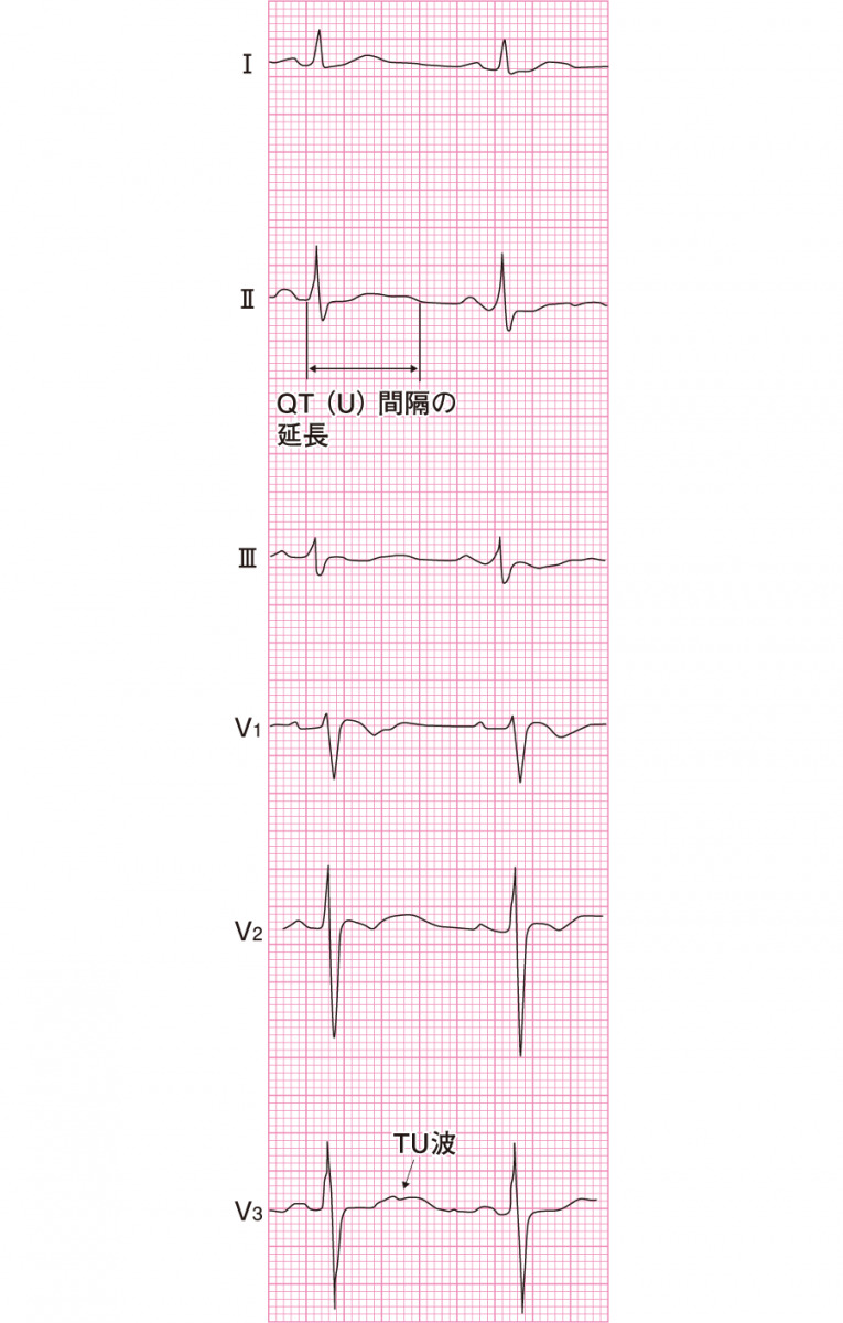 低カリウム血症の心電図